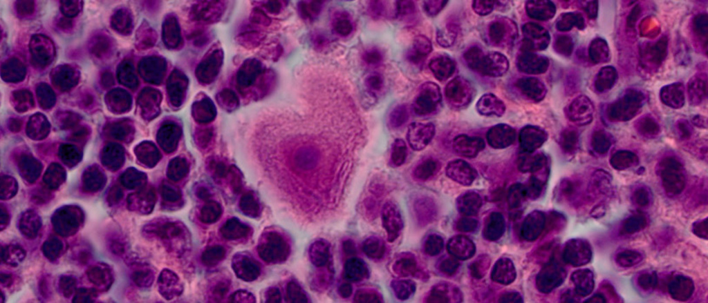 Lymph Nodes and Related Specimens | University of Iowa Diagnostic ...