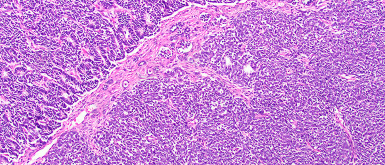 Microscope image of a tumor