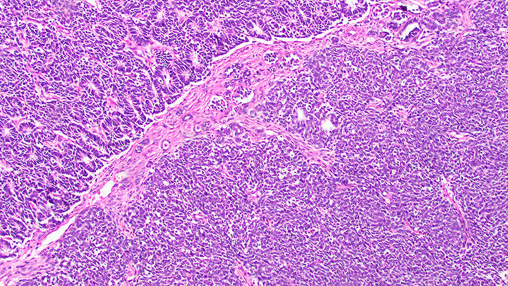 Microscope image of a tumor